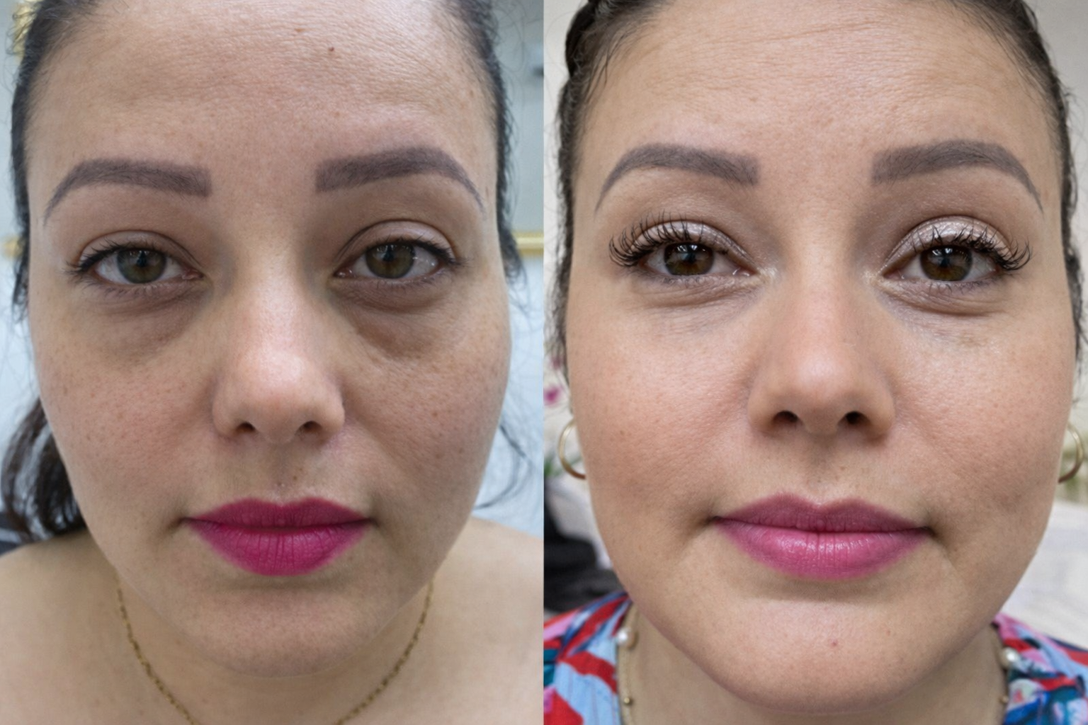 Antes y Después: rejuvenecimiento facial con rellenos de ácido hialurónico