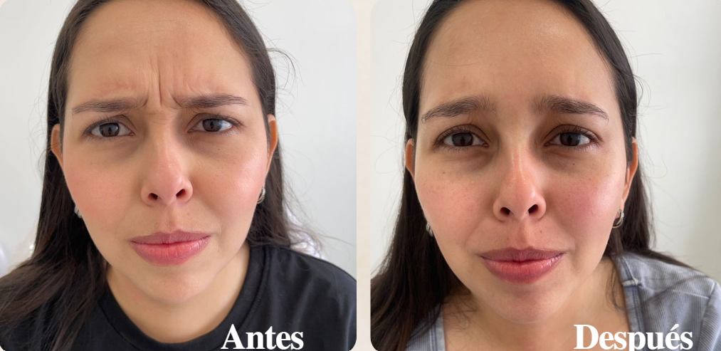 Antes y Después: reducción de líneas de expresión con botox